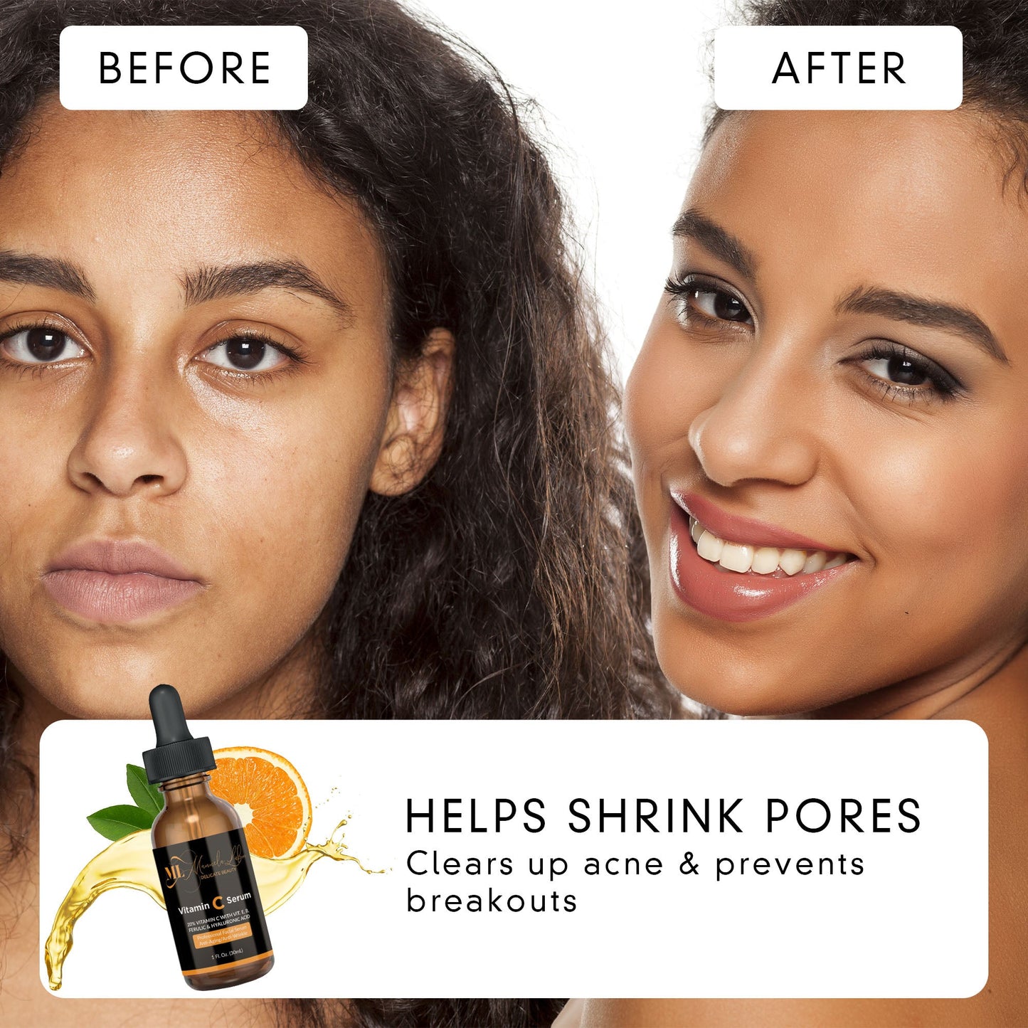 Acne Resolve + Radiant Skin Advanced Anti-Aging Vitamin C Serum,